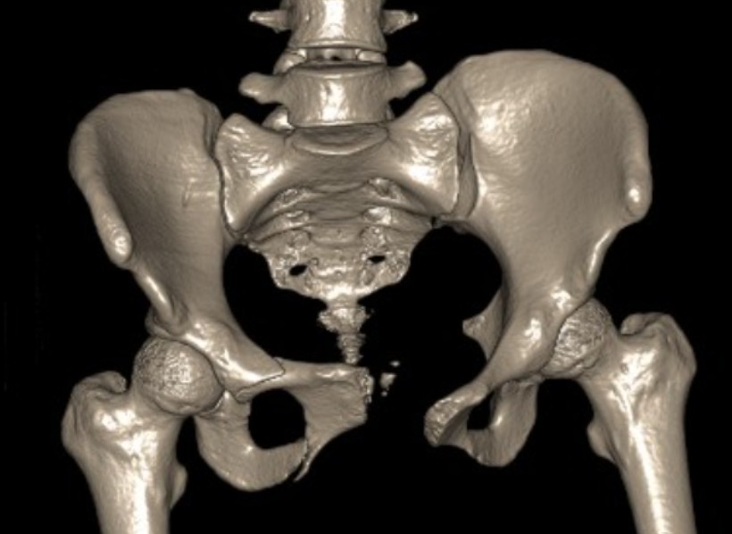 Pelvic injury